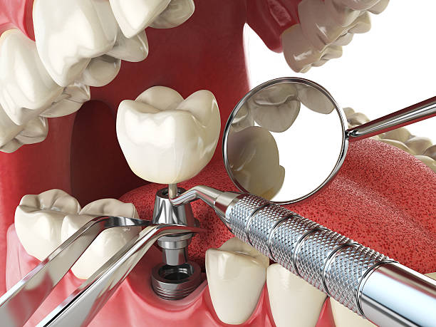 Best Emergency Tooth Extraction in Lithonia, GA
